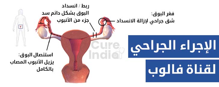 أسباب أعراض انسداد قناة فالوب